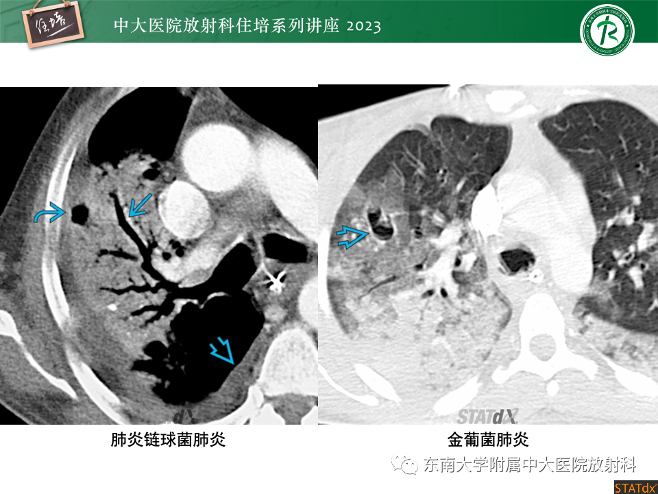 肺部特殊感染影像分析-28