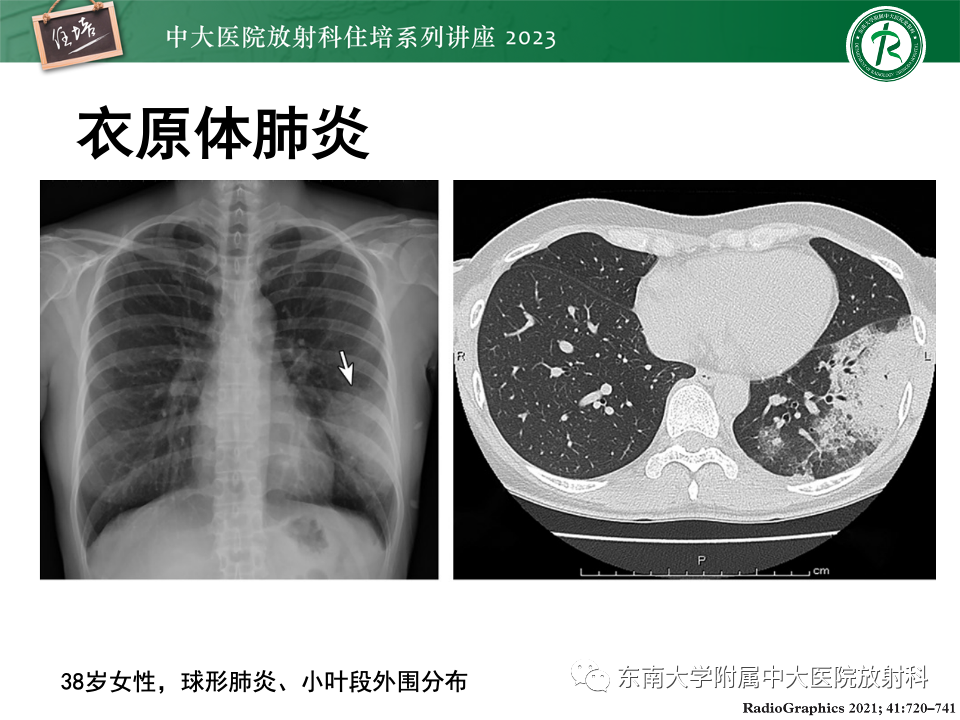 肺部特殊感染影像分析-31