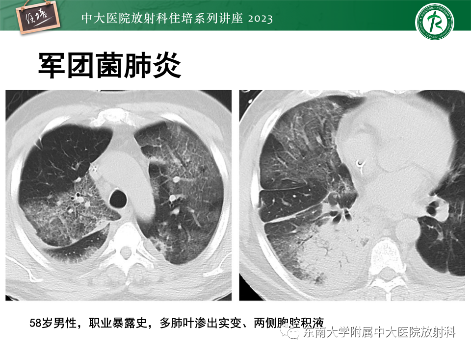 肺部特殊感染影像分析-33