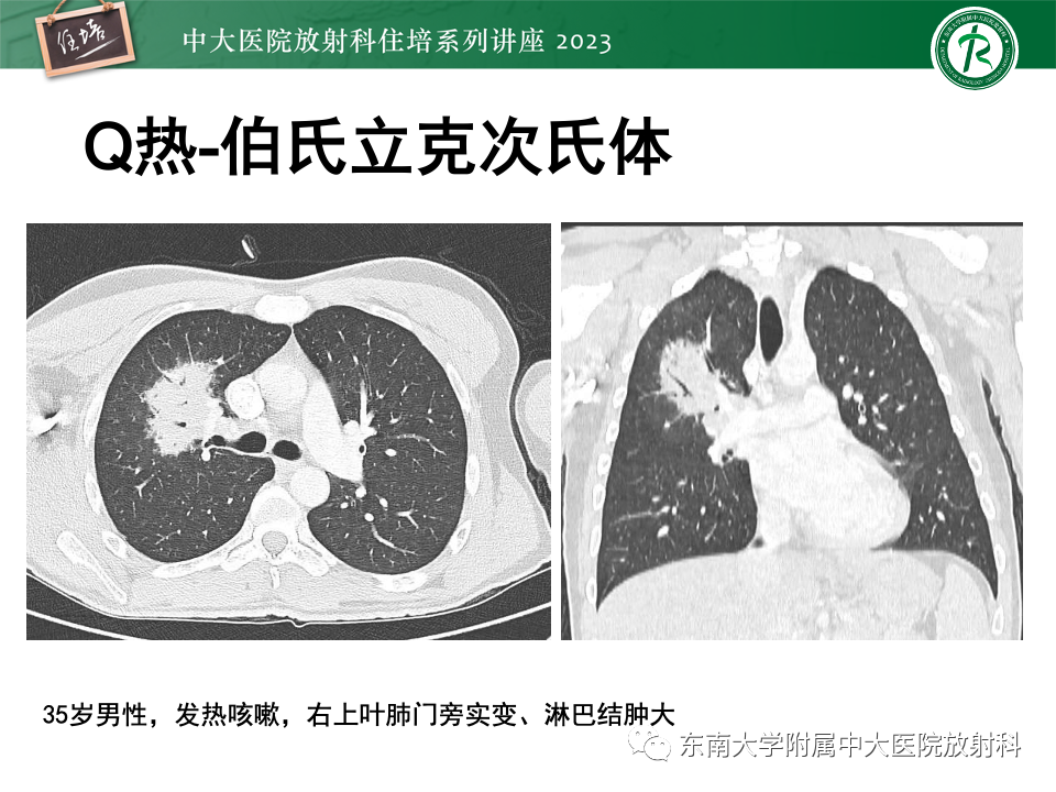 肺部特殊感染影像分析-35