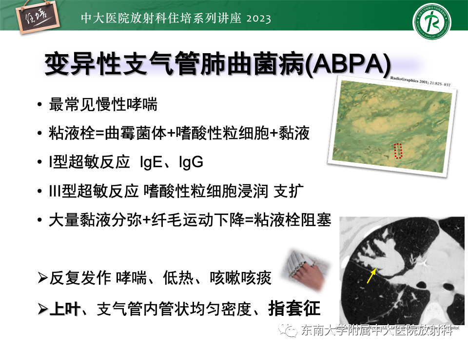 肺部特殊感染影像分析-38