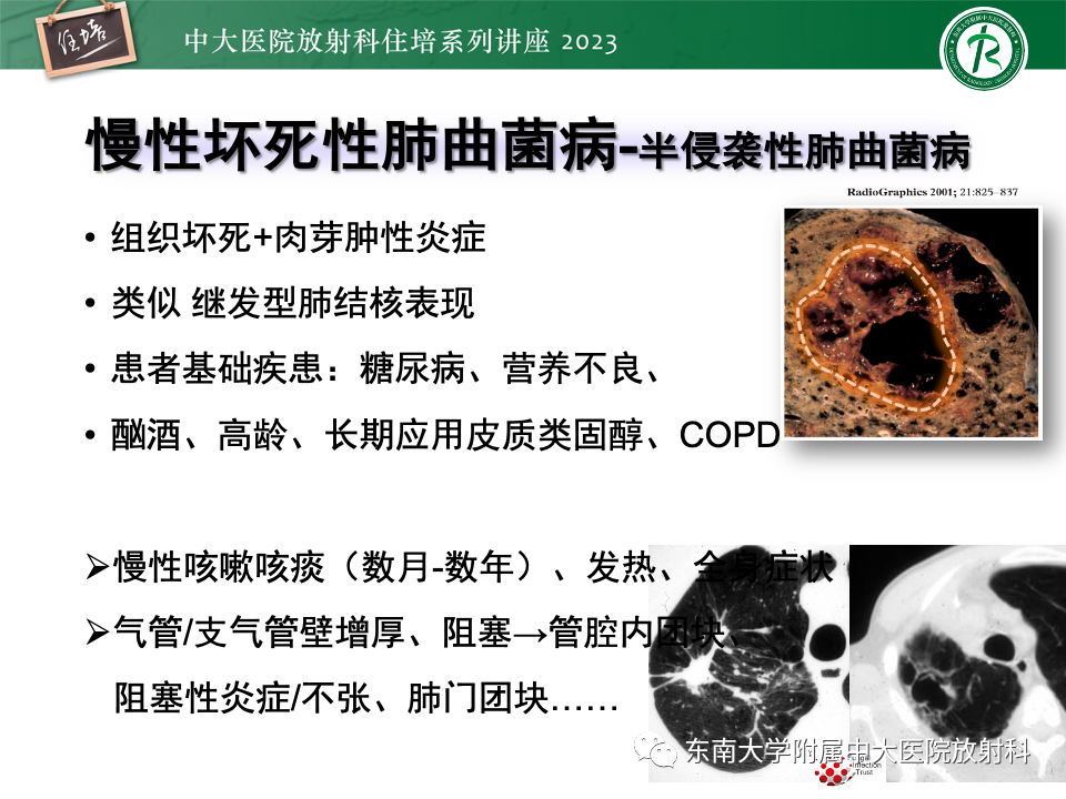 肺部特殊感染影像分析-39