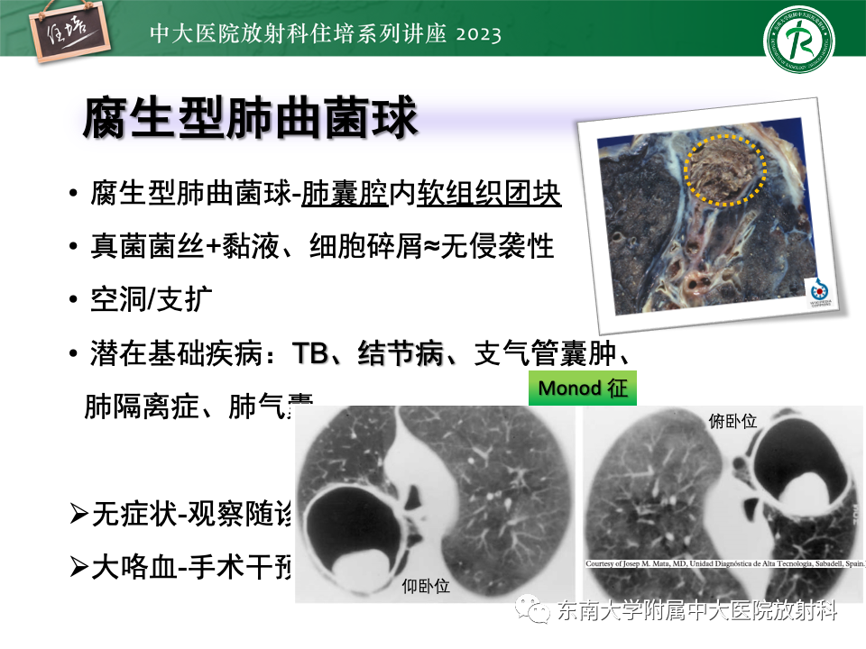 肺部特殊感染影像分析-37