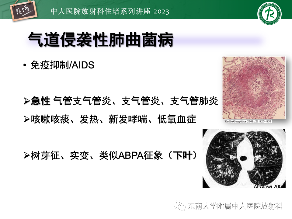 肺部特殊感染影像分析-40