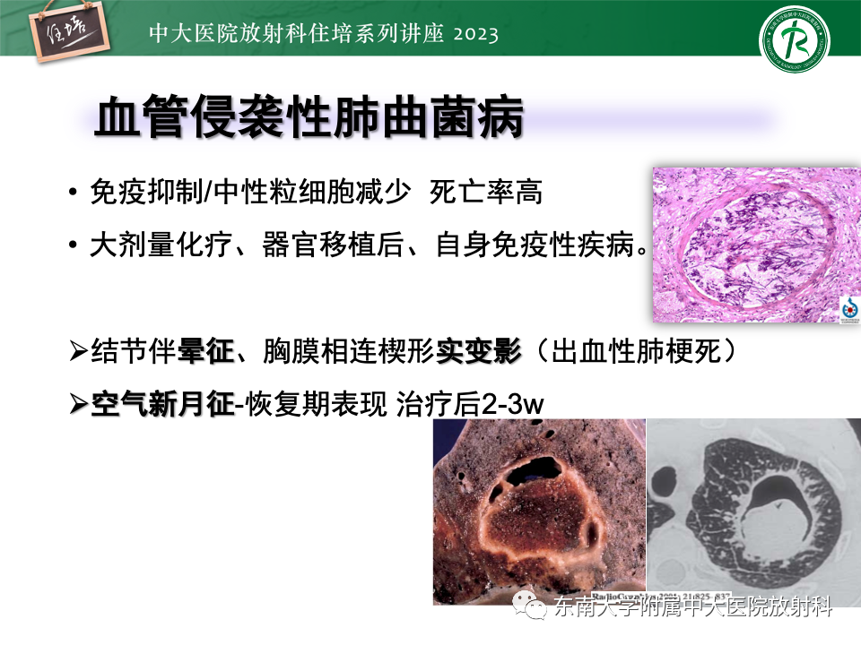 肺部特殊感染影像分析-41