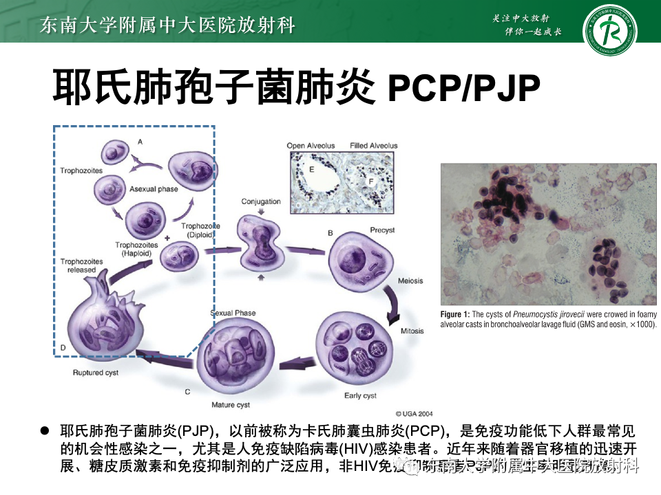 肺部特殊感染影像分析-42