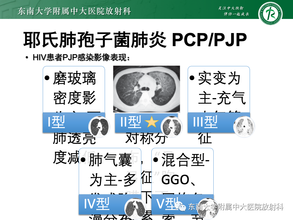 肺部特殊感染影像分析-43