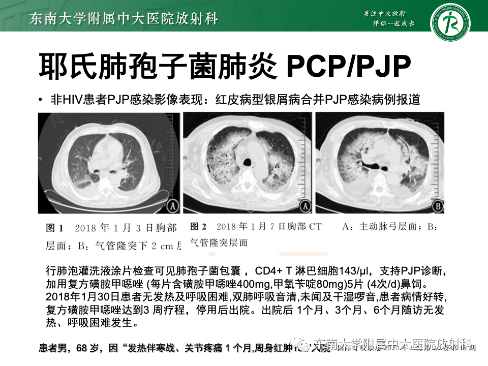 肺部特殊感染影像分析-45