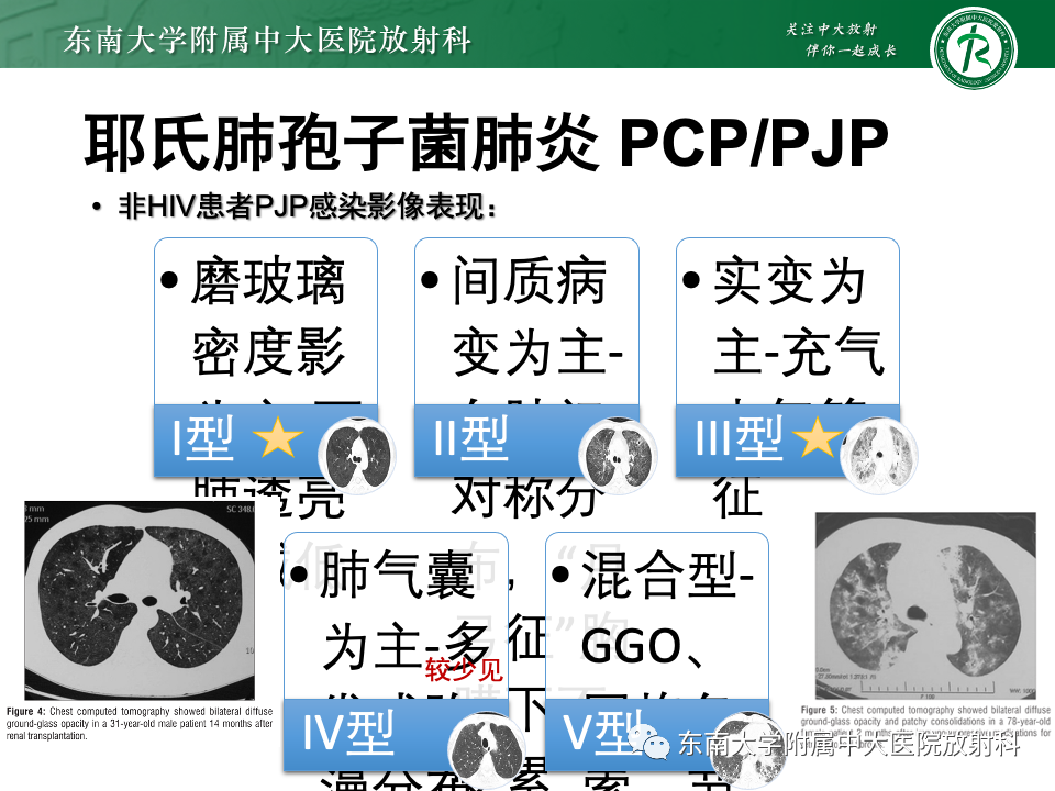 肺部特殊感染影像分析-44