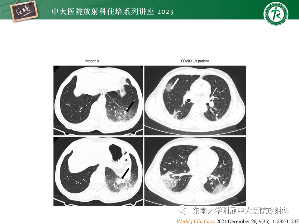肺部特殊感染影像分析-49