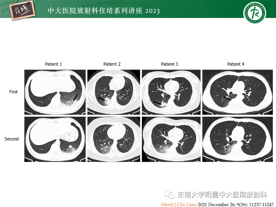肺部特殊感染影像分析-50