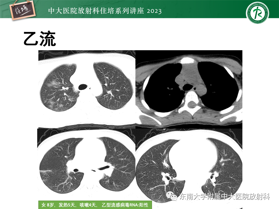 肺部特殊感染影像分析-52