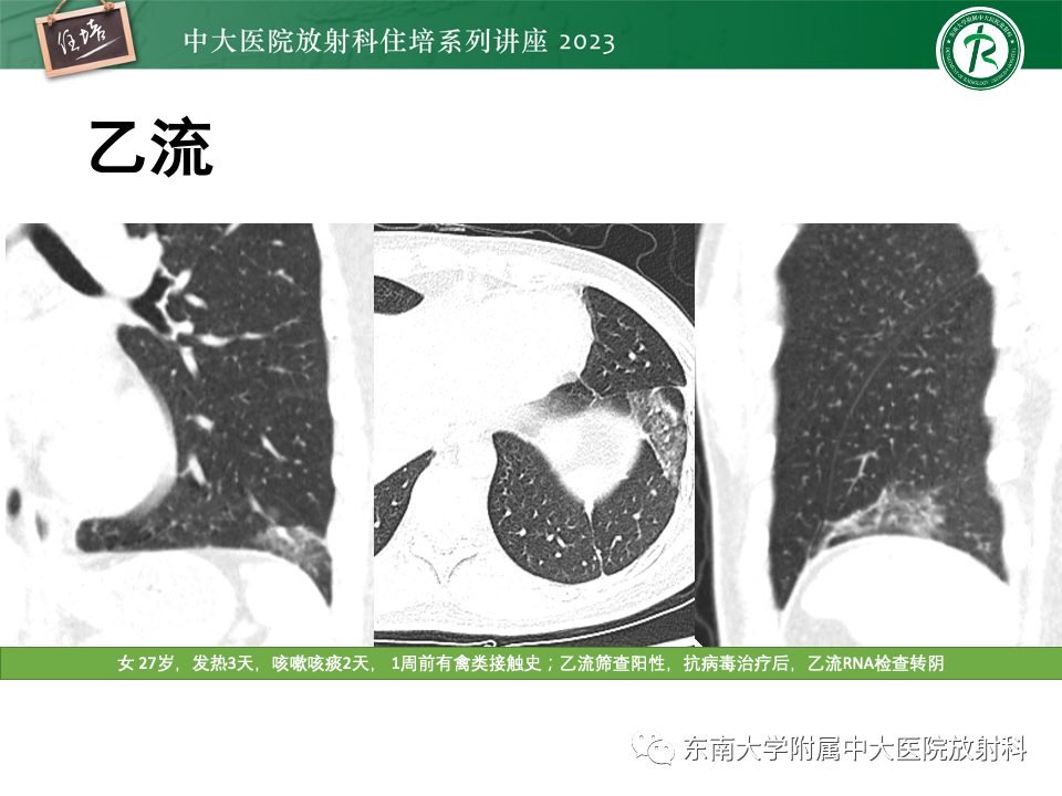 肺部特殊感染影像分析-51