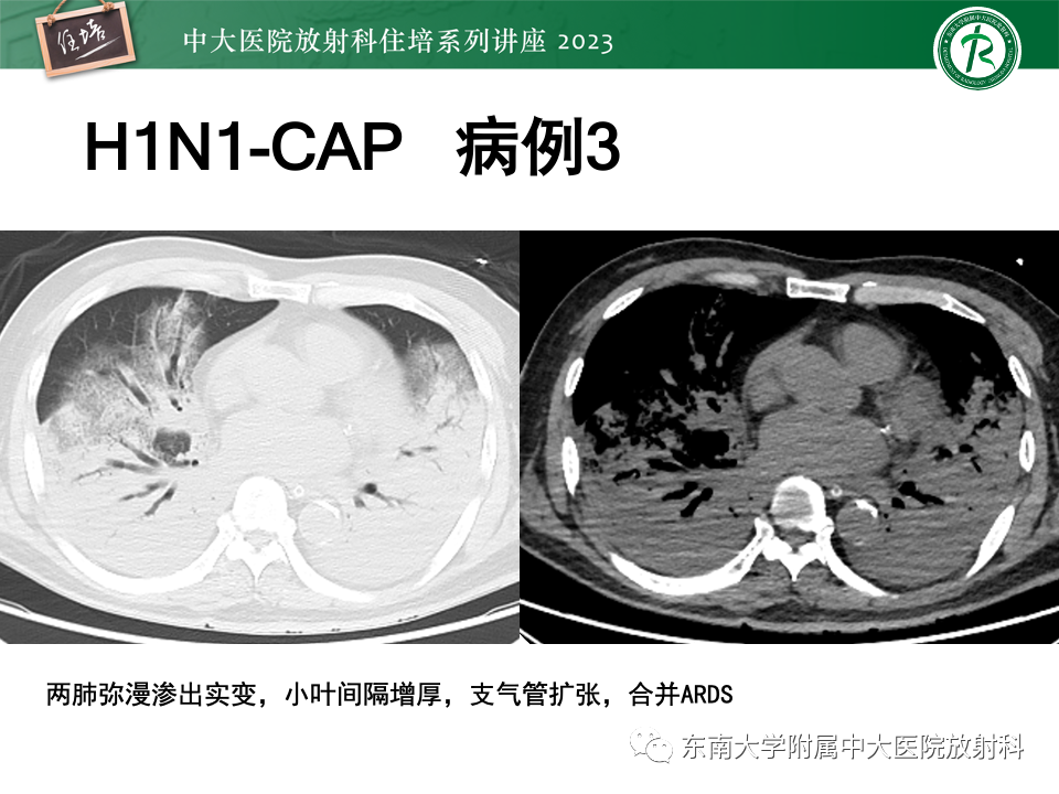 肺部特殊感染影像分析-58