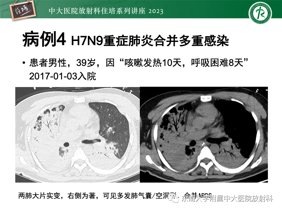 肺部特殊感染影像分析-60