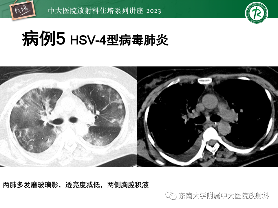 肺部特殊感染影像分析-62
