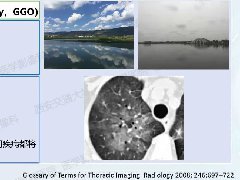肺部弥漫性GGO的诊断分析-2