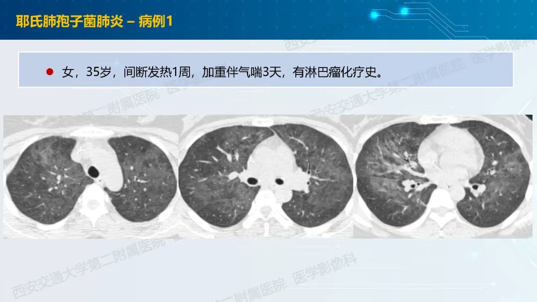 肺部弥漫性GGO的诊断分析-8