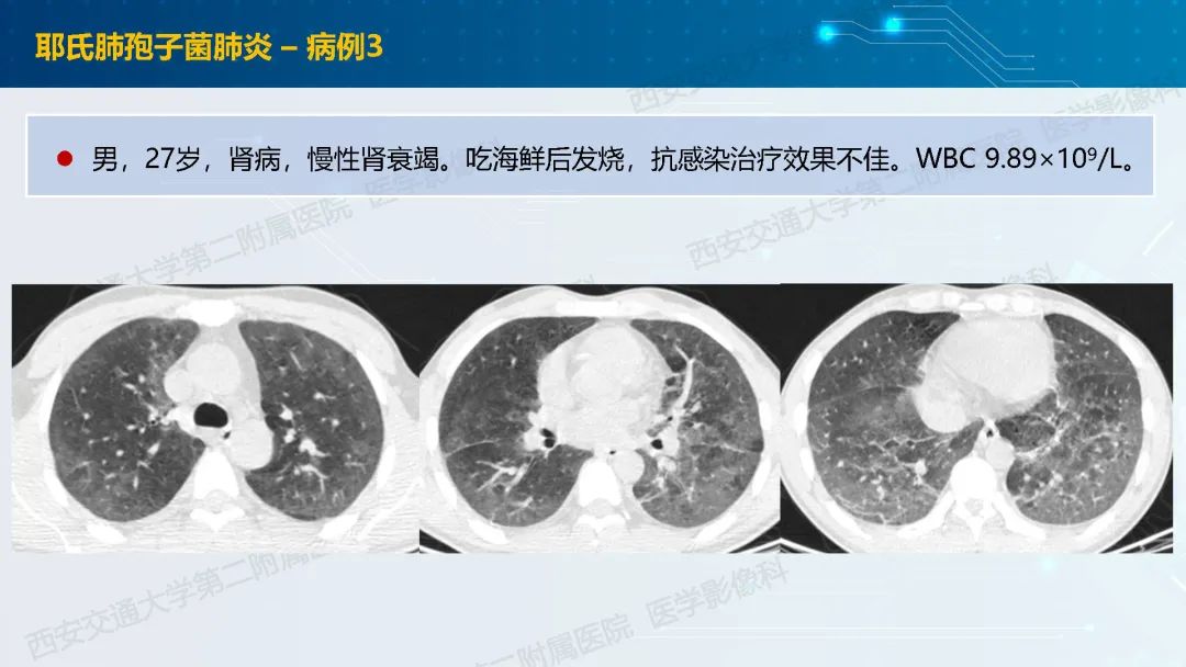 肺部弥漫性GGO的诊断分析-10