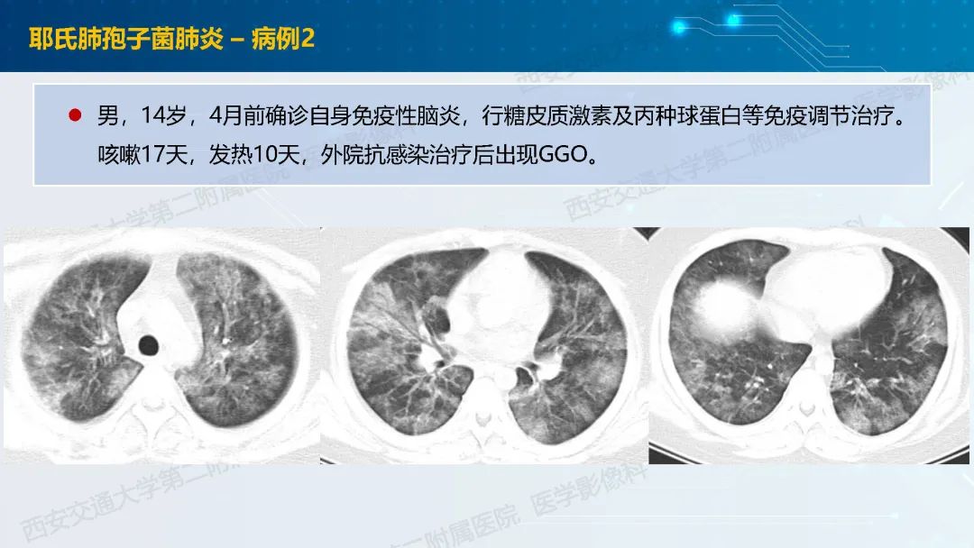 肺部弥漫性GGO的诊断分析-9