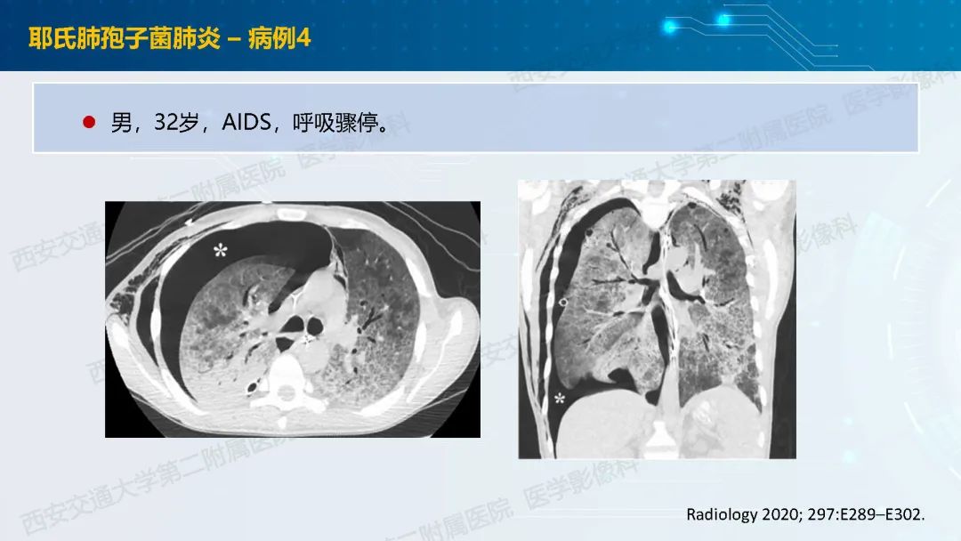 肺部弥漫性GGO的诊断分析-11