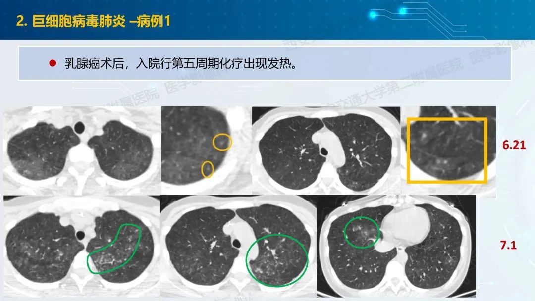 肺部弥漫性GGO的诊断分析-13