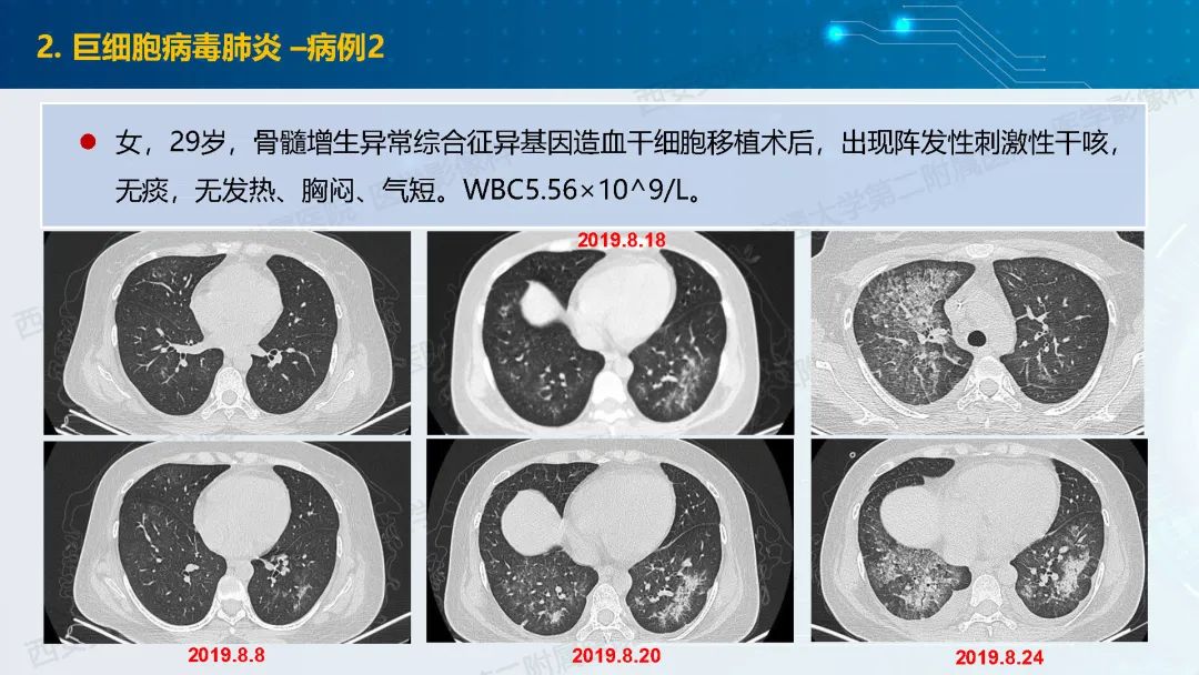 肺部弥漫性GGO的诊断分析-14
