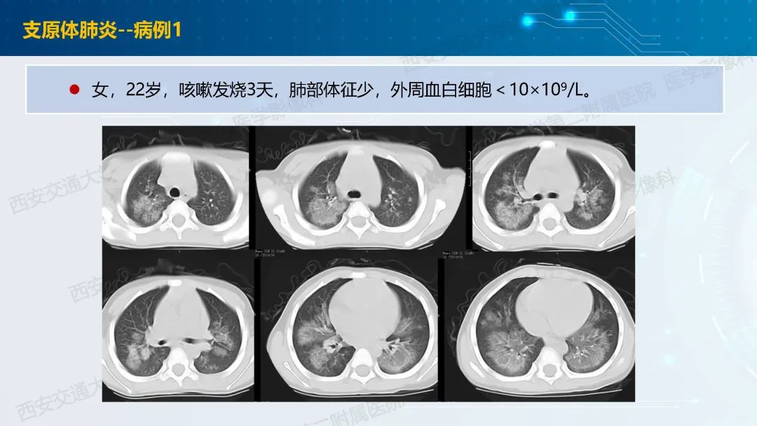 肺部弥漫性GGO的诊断分析-16