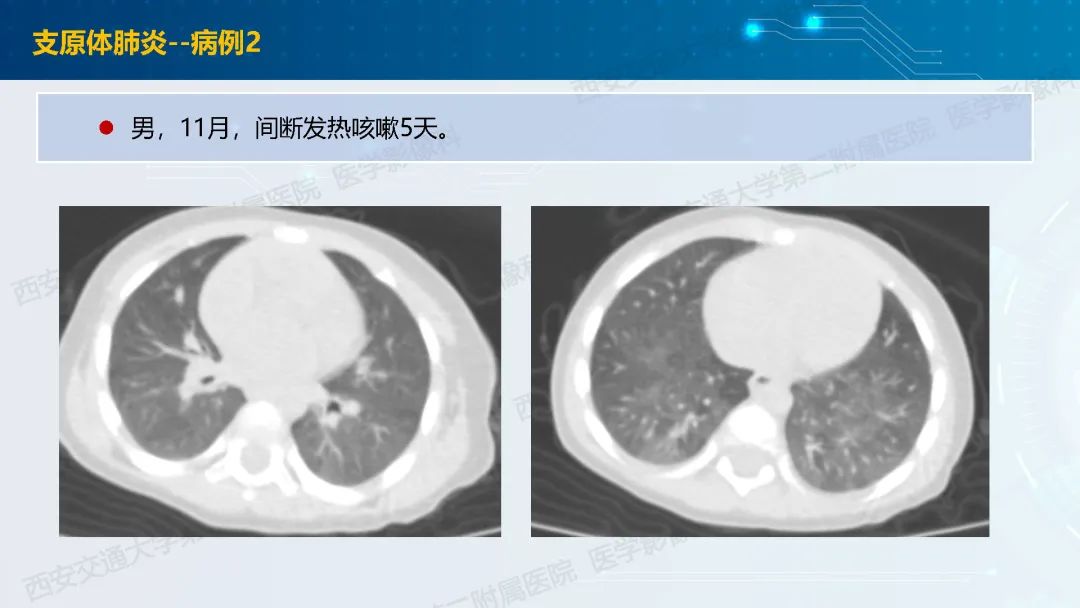 肺部弥漫性GGO的诊断分析-17