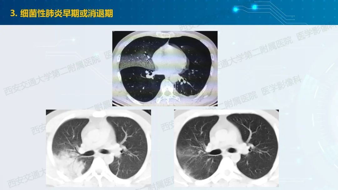 肺部弥漫性GGO的诊断分析-18