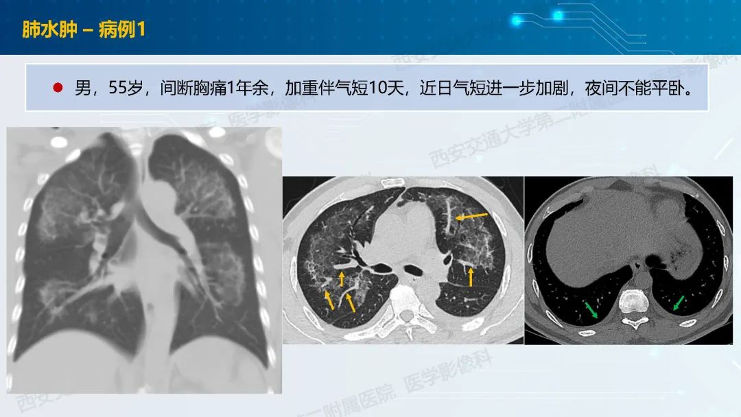 肺部弥漫性GGO的诊断分析-20