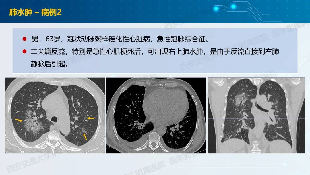 肺部弥漫性GGO的诊断分析-21