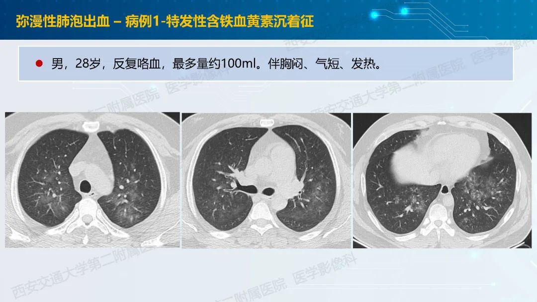 肺部弥漫性GGO的诊断分析-24