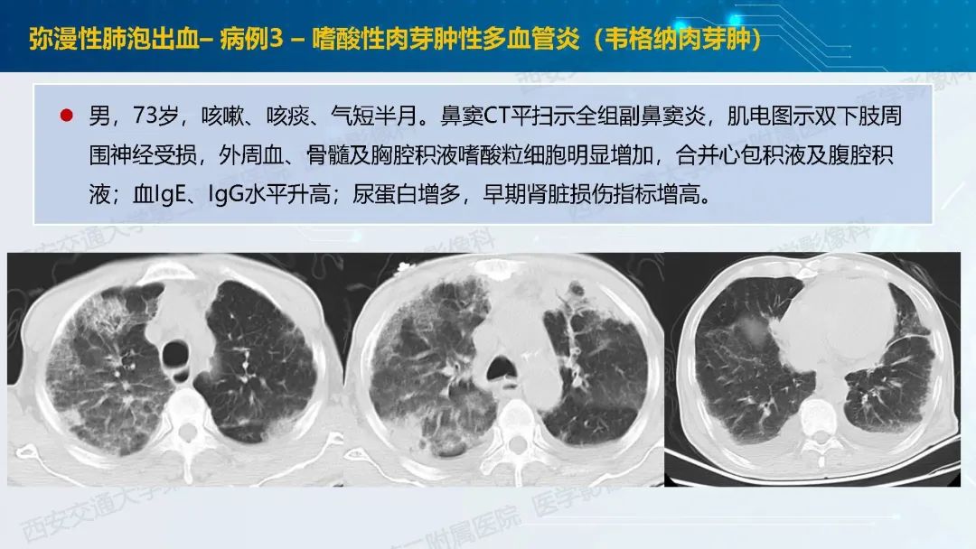 肺部弥漫性GGO的诊断分析-27