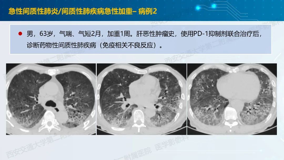 肺部弥漫性GGO的诊断分析-30