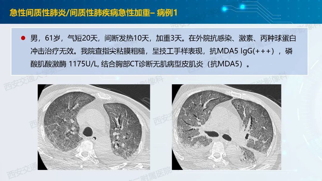 肺部弥漫性GGO的诊断分析-29