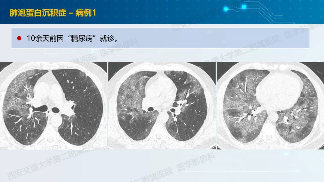 肺部弥漫性GGO的诊断分析-33