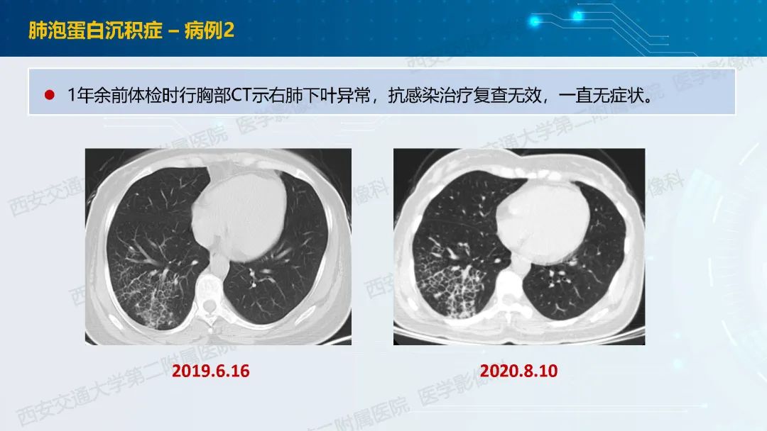 肺部弥漫性GGO的诊断分析-34