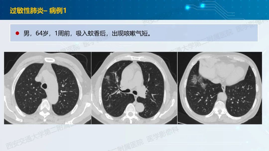 肺部弥漫性GGO的诊断分析-36