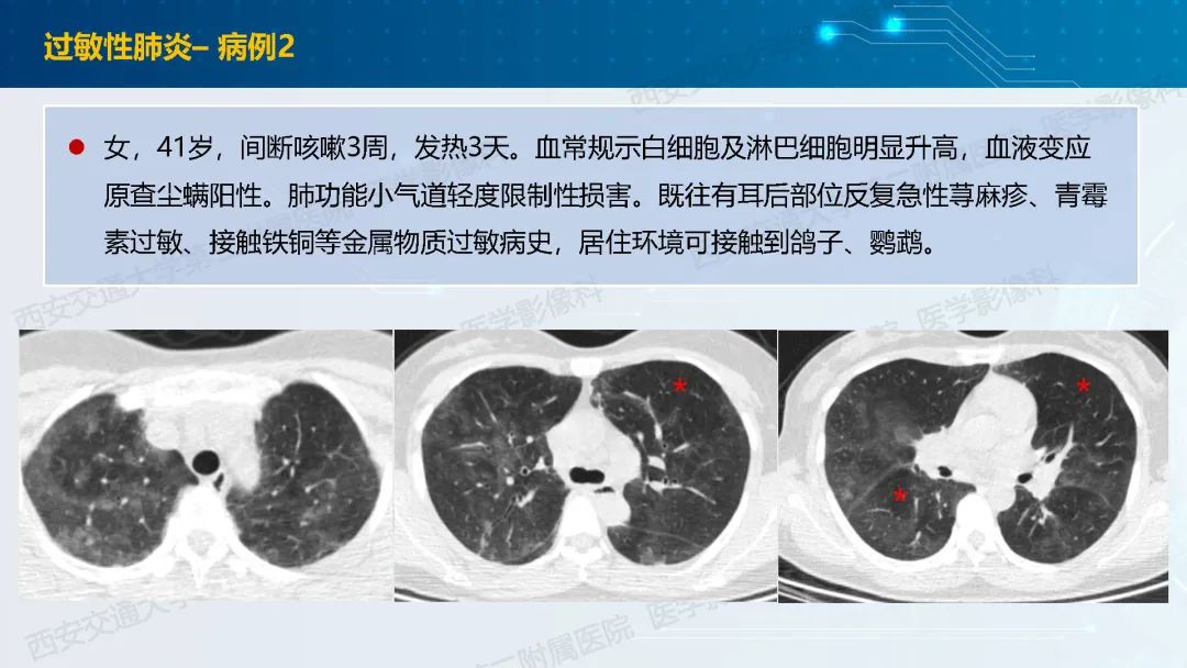 肺部弥漫性GGO的诊断分析-37