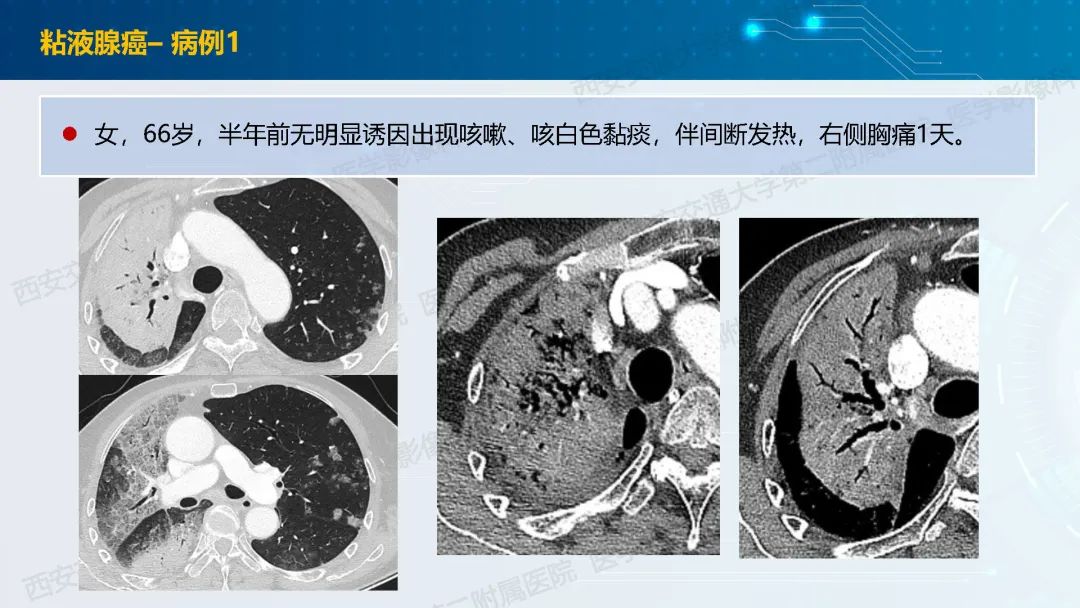 肺部弥漫性GGO的诊断分析-39