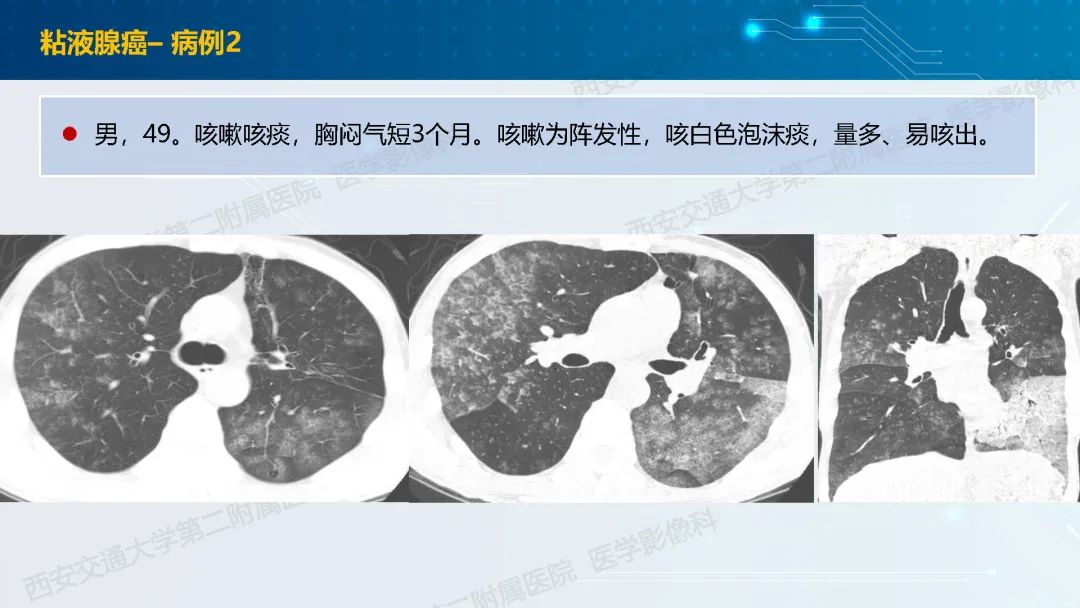 肺部弥漫性GGO的诊断分析-40