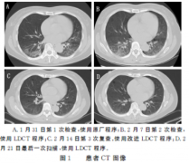 应用改进低剂量组CT技术检查新型冠状病毒肺炎确