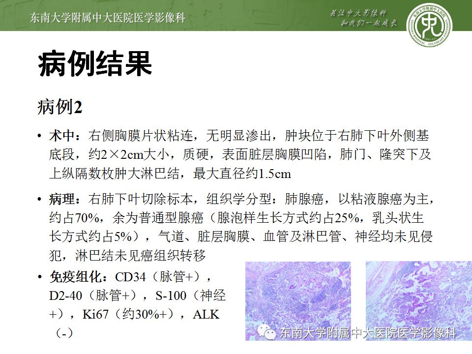 【PPT】局灶性机化性肺炎与周围型肺癌的鉴别-10