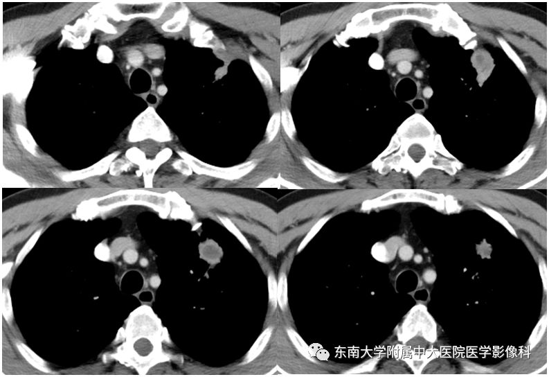 【PPT】局灶性机化性肺炎与周围型肺癌的鉴别-3