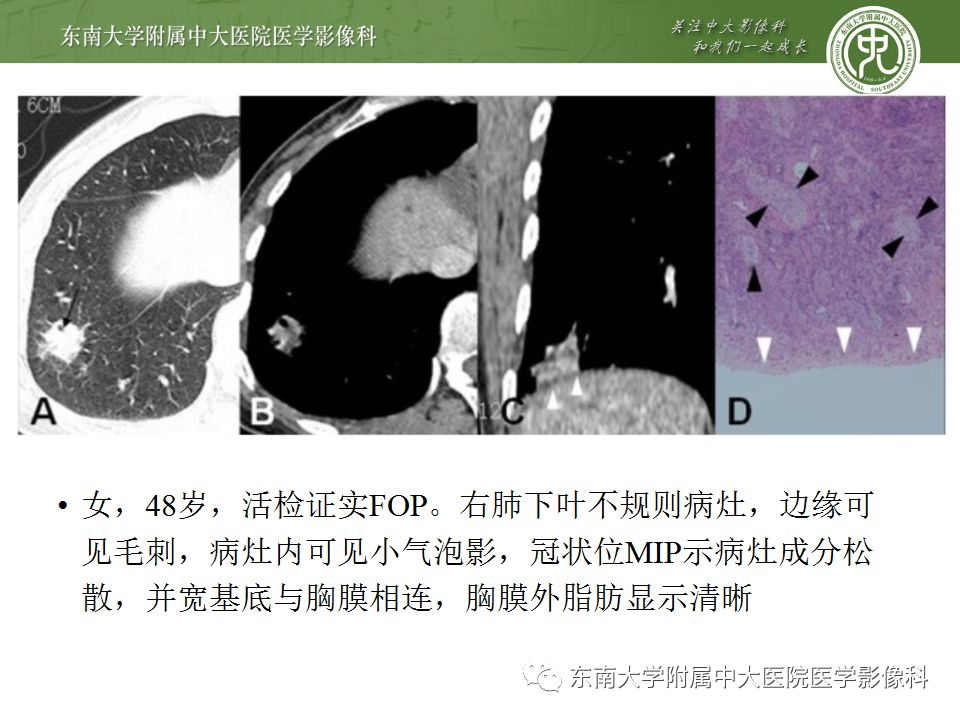 【PPT】局灶性机化性肺炎与周围型肺癌的鉴别-21