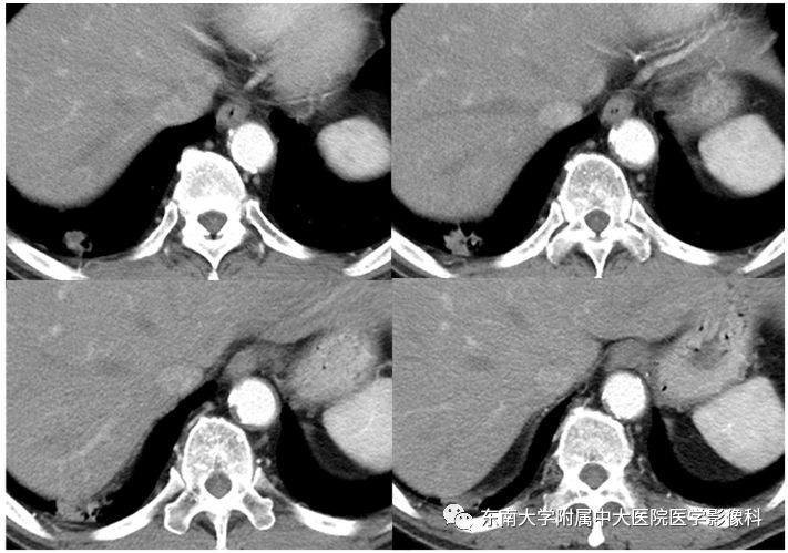 【PPT】局灶性机化性肺炎与周围型肺癌的鉴别-7