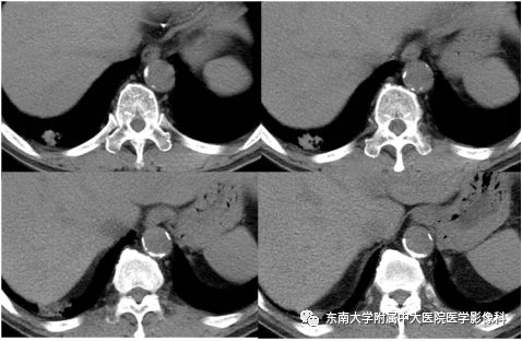 【PPT】局灶性机化性肺炎与周围型肺癌的鉴别-6