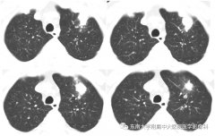 局灶性机化性肺炎与周围型肺癌的鉴别