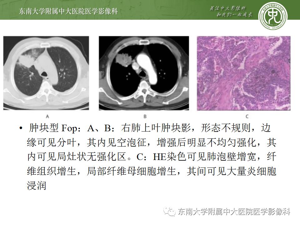 【PPT】局灶性机化性肺炎与周围型肺癌的鉴别-19